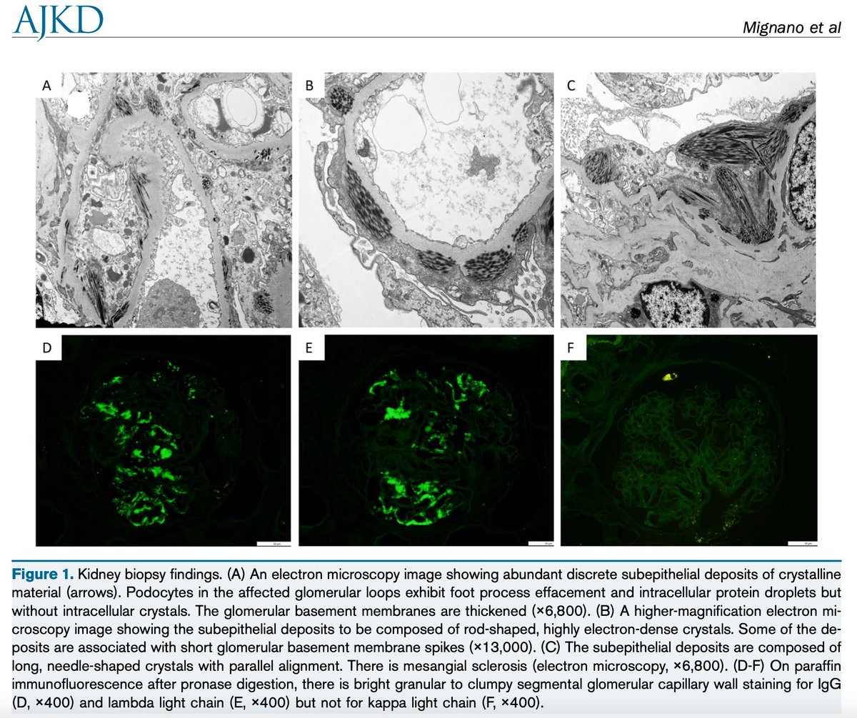 Monoclonal Immunoglobulin Crystalline Membranous Nephropathy: A Case Report

buff.ly/3wrUuiM 

@SethiRenalPath @mayocliniclabs