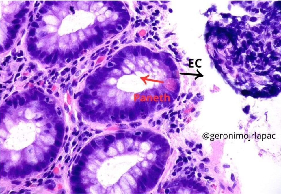 Nice pic with two types of cells side by side. Examining a sample of the left colon and rectum, we know that a paneth cell is a sign of chronicity. A mistake is to confuse it with Enterochromaffin (EC) cells. 🎯Tip: Paneth = granules to lumen; EC = periphery granules #gipath