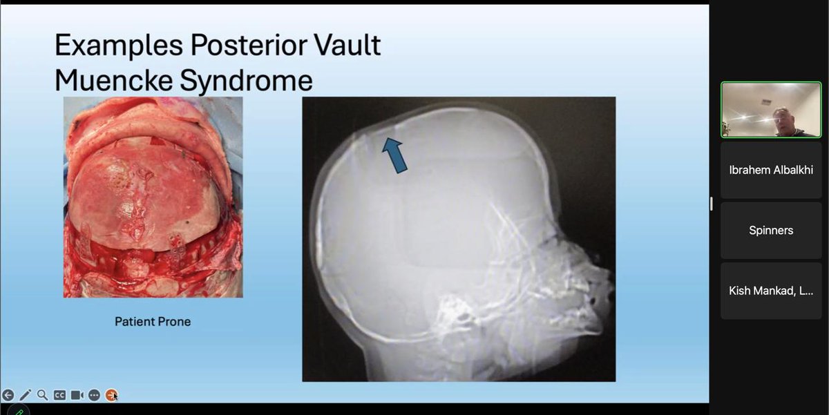 What is craniosynostosis and how should it be managed? Learn it from Professor Anderson, full recording uploaded now on your member's elearning portal, visit spinacademics.org. Don’t miss out on our monthly clinical experts this year.