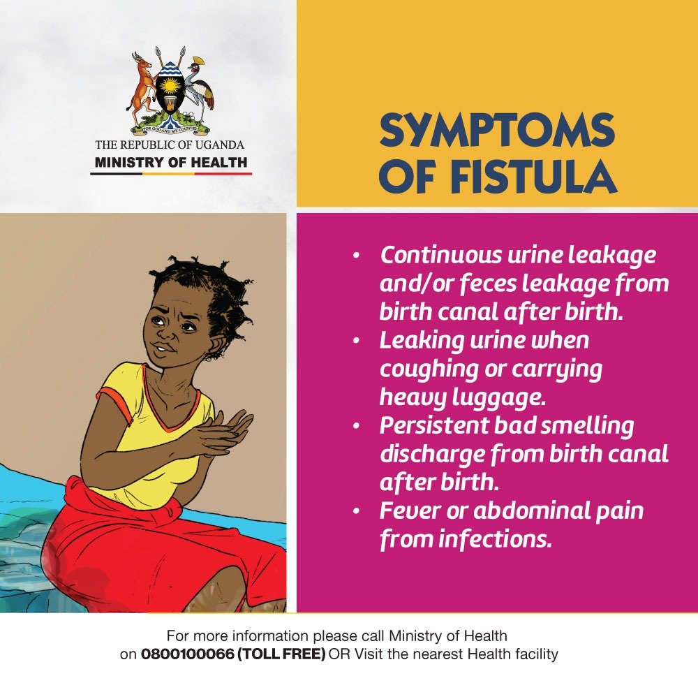 A fistula is an abnormal connection between two body parts, such as organs or vessels, that normally do not connect. They can form in various parts of the body, including the digestive system, urinary tract, and reproductive organs. #EndFistula