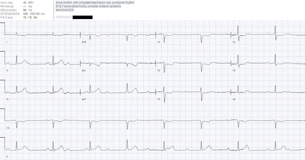 Chest pain: Are these really 'Nonspecific ST-T wave abnormalities', as the cardiologist interpretation states? hqmeded-ecg.blogspot.com/2024/05/chest-… @ECGcases