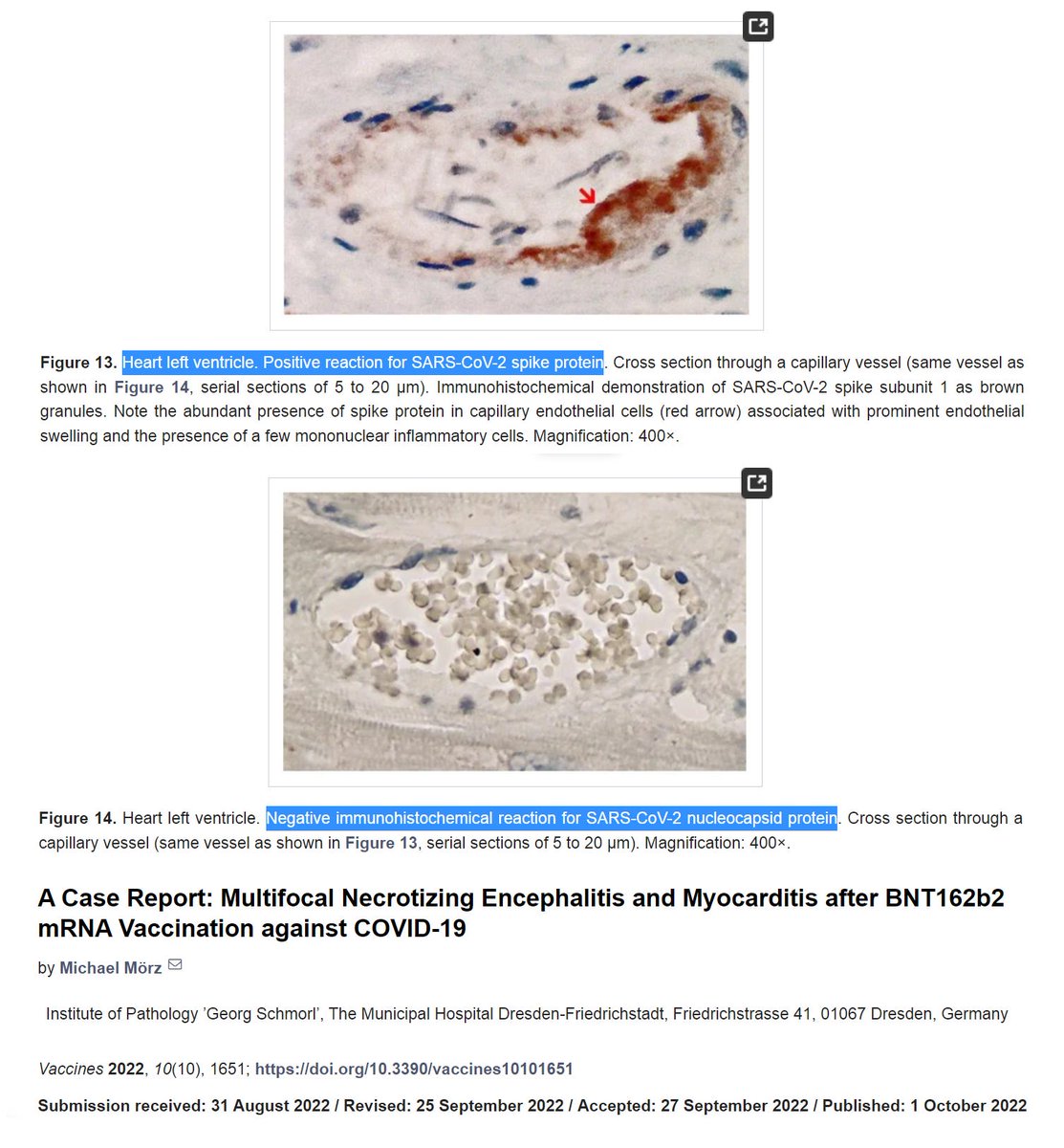 NEW ARTICLE: UK Pathologist rules 36 year old mom most likely died from Pfizer COVID-19 mRNA Vaccine 11 days after her 1st dose Why proper autopsies of Vaccine victims are STILL not being done 3 years into global vaccination UK Pathologist rules 36 yo Dawn Wooldridge most