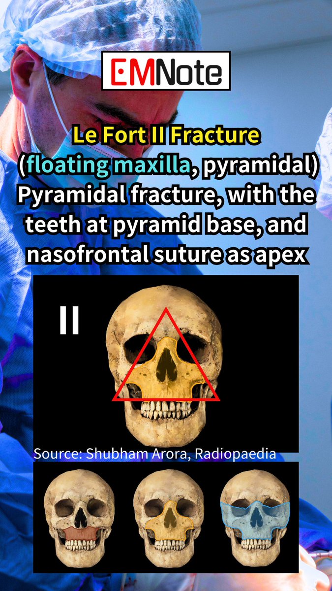 Le Fort fractures youtube.com/shorts/FhQmw3P… Higher Le Fort fractures are more unstable, increasing the risk of airway compromise from hemorrhage, edema, and bony fragment displacement. Be prepared for definitive airway management.