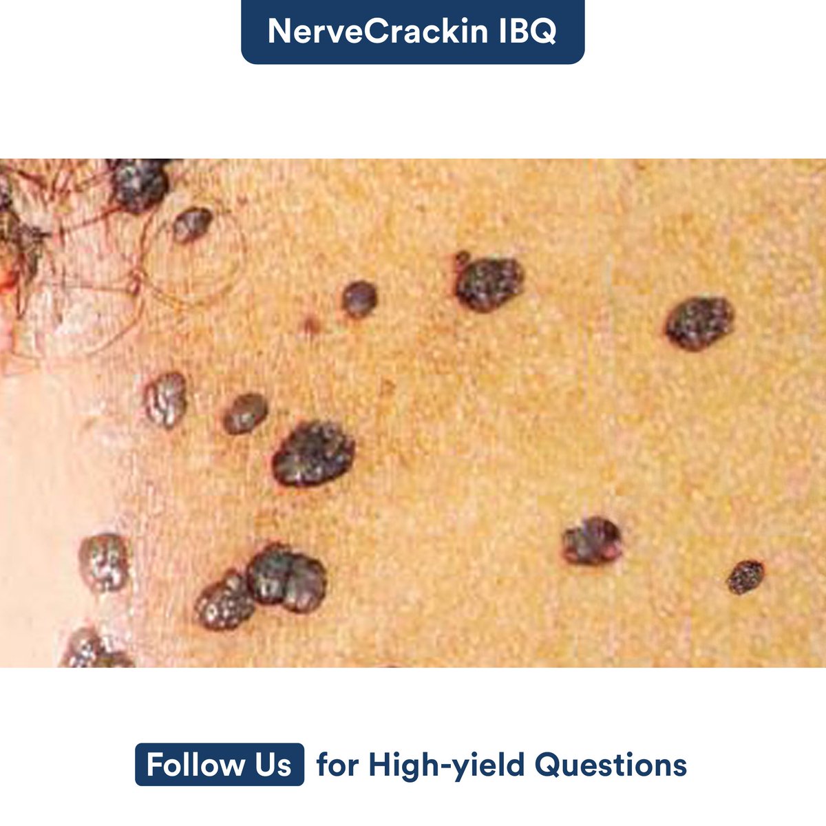 What does the given picture represent? 

A. Bowenoid papulosis  
B. Filiform warts 
C. Molluscum contagiosum 
D. Trigeminal zoster 

#DigiNerve #IBQ #NerveCrackin #zoster #MedicalImaging #Bowenoid #papulosis #Filiform #answer #PracticeMCQ #MedicalImaging #MCQ