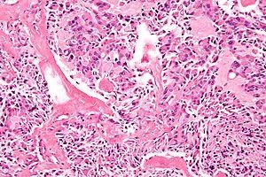 cuttingedgempl's tweet photo. Male patient with 1 cm nodule in Right side of Thyroid. Biopsy shows medullary carcinoma. No neck nodes are seen on USG. #cuttingedgemanipal #surgery
#surgicalmcq #kmcmanipal #medullarycarcinoma #thyroid https://t.co/ibioo3vbhK
