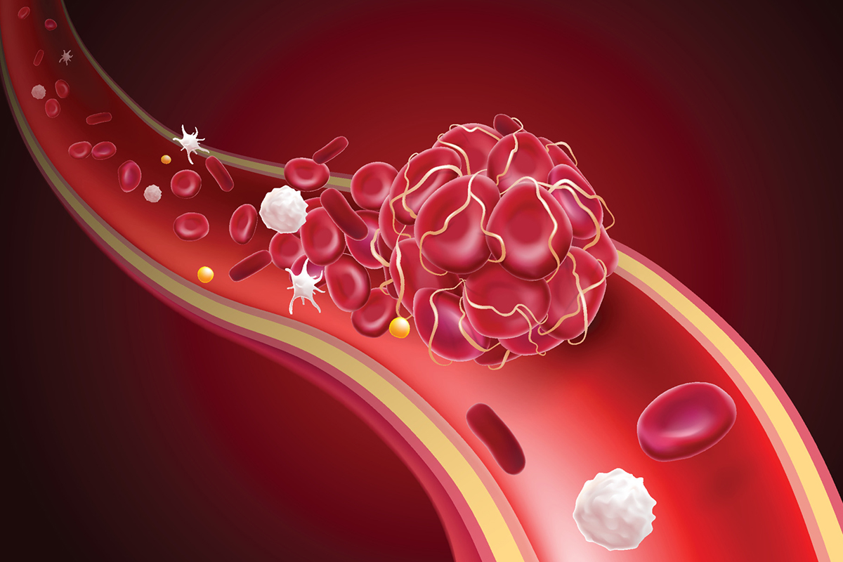 A novel medicine, SP-420, is currently being tested in a Phase II #clinicaltrial (THAL-01) as a potential #treatment for #ironoverload in adult #patients with transfusion-dependent ß-#thalassaemia (TDT). ➡️ thalassaemia.org.cy/clinical-trial…