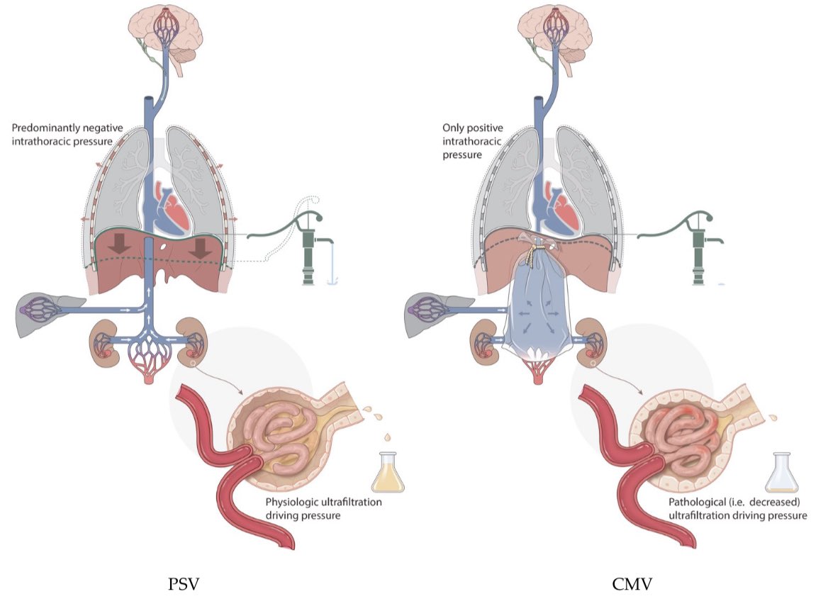 Mark GN (@markoo7s) on Twitter photo “Venous Bagging”, an interesting theory in patients with mechanical ventilation that develops Acute Kidney Injury - VILI/VIKI <a href="/NefrologiaINER/">Nefrología INER</a>
doi.org/10.3390/jcm130… “Venous Bagging”, an interesting theory in patients with mechanical ventilation that develops Acute Kidney Injury - VILI/VIKI <a href="/NefrologiaINER/">Nefrología INER</a>
doi.org/10.3390/jcm130…