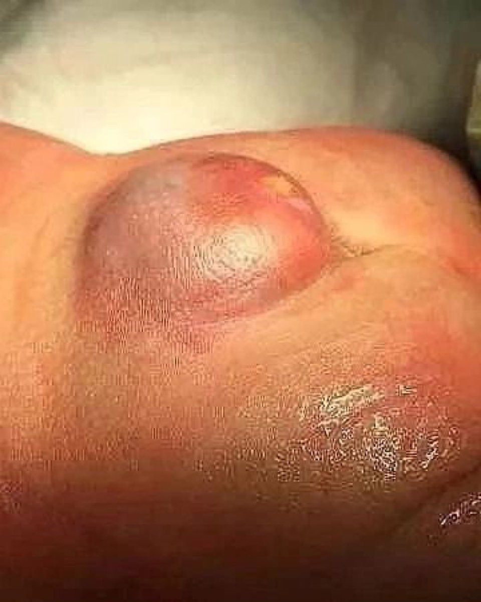 Doctors__squad's tweet image. A child born with a failure of the spine to close over into a proper canal. The lump is a #combination of nerves and skin exposed to the air, what's your #diagnosis?