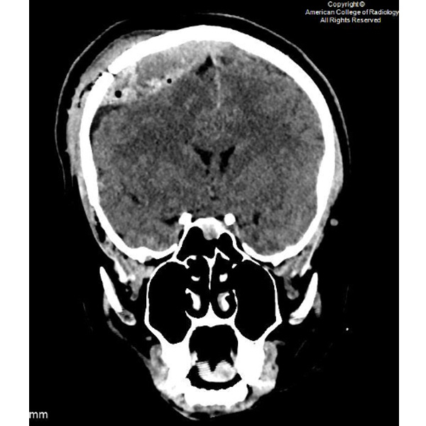 A 28-year-old man presents to the ER with an acute change in mental status after being struck by a car going 35 mph while riding a bicycle without a helmet. #ACRCaseinPoint bit.ly/3UwsSCz