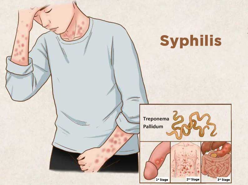 🚨 The Jarisch-Herxheimer reaction (JHR) is a temporary adverse reaction that can occur following treatment of syphilis infection with penicillin or other antibiotics:

🔹It results from the rapid release of endotoxins into the bloodstream as the bacteria (Treponema pallidum) are