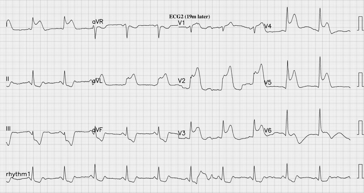 CP w life-changing event in 19m!
Dx?
@UlhasDr @DidlakeDW @ecgrhythms @IhabFathiSulima @DocNikko @DrPharmDMDTh @Vadeboncoeur_Al @smithECGBlog @EM_RESUS @iamritu @paomorejon @martinfd78 @estudiomedicina @OrlandoRPN @fxgodzeuss #Cardioed #FOAMcc @akneton @ecgandrhythmRoe