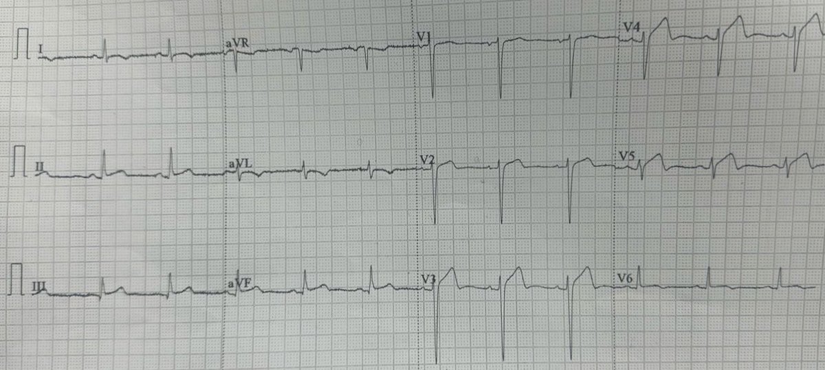 Chest pain Dx ?