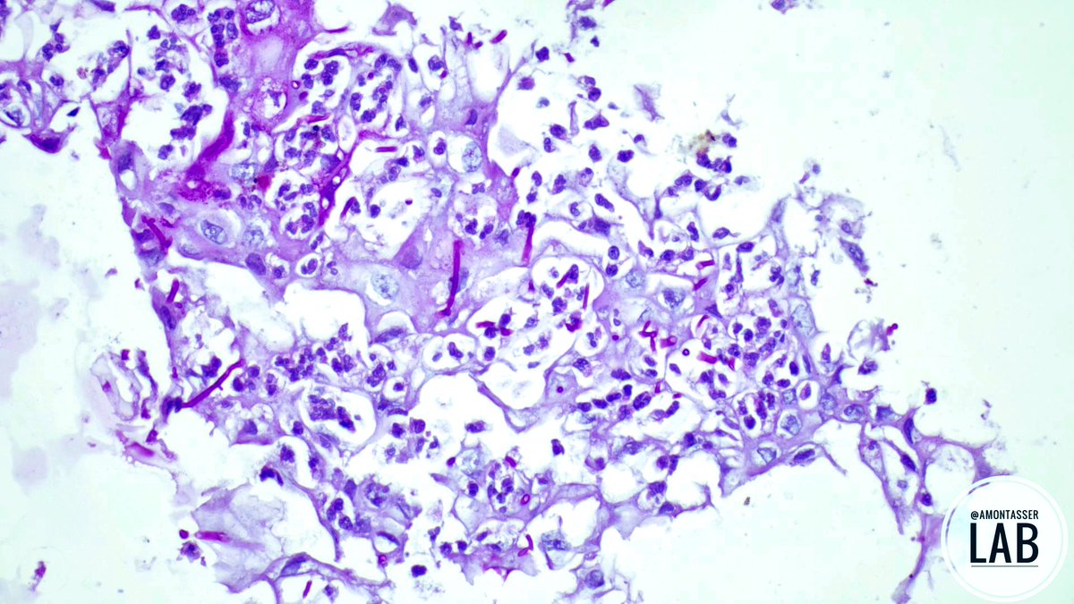 🔬 Candida esophagitis (HE & PAS)

#GIpath #Pathology #PathTwitter #PathX