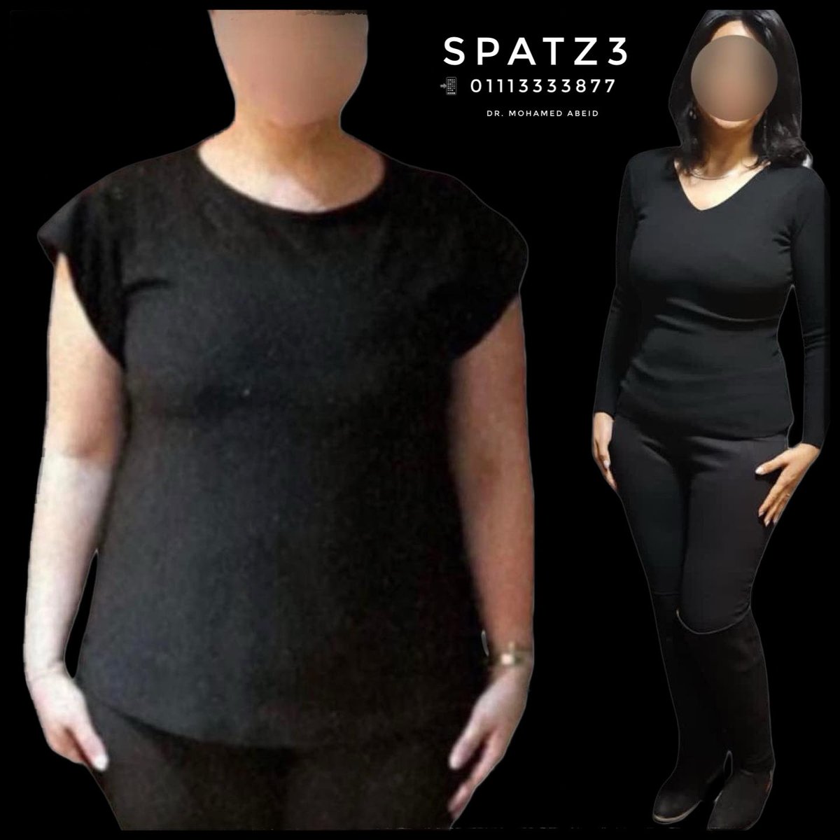 MohamedAbeid's tweet image. 100 % EWL
#SPATZ3
#WeightLoss
#OBESITY