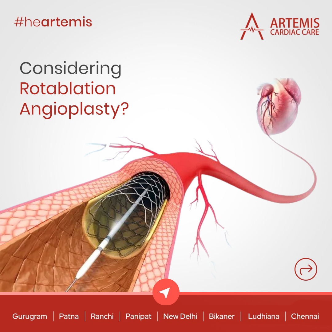 ArtemisCardiac's tweet image. Is #Rotablation #Angioplasty right for you? Explore options for severe #coronary artery disease with our expert #cardiologist at Artemis #Cardiac #Care today.