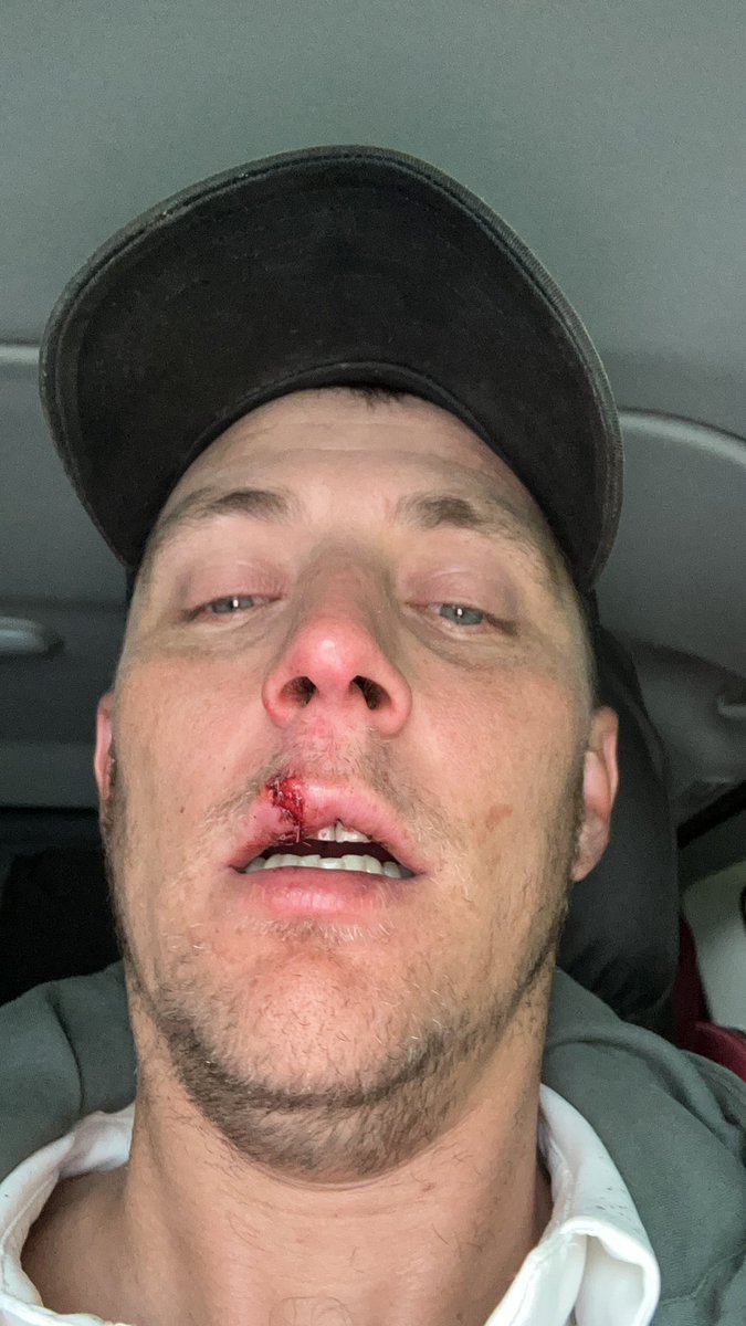 Lovely bank holiday in an and e 16 stitches after my lip was split by a top edge luckily no teeth damaged! I should
Learn not to miss a half volley going to cow corner.