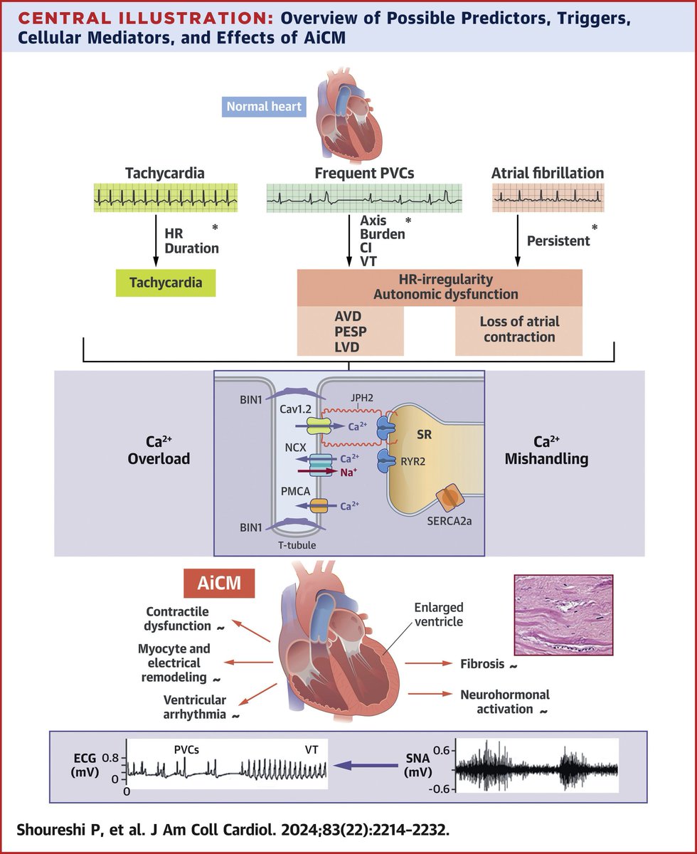 🔴 Arrhythmia-Induced Cardiomyopathy: JACC State-of-the-Art Review #openaccess #2024Review 

jacc.org/doi/10.1016/j.…
#Cardiology #Epeeps #CardioTwitter #MedEd #medical #medtwitter #cardiotwiteros #CardioEd #Cardiox