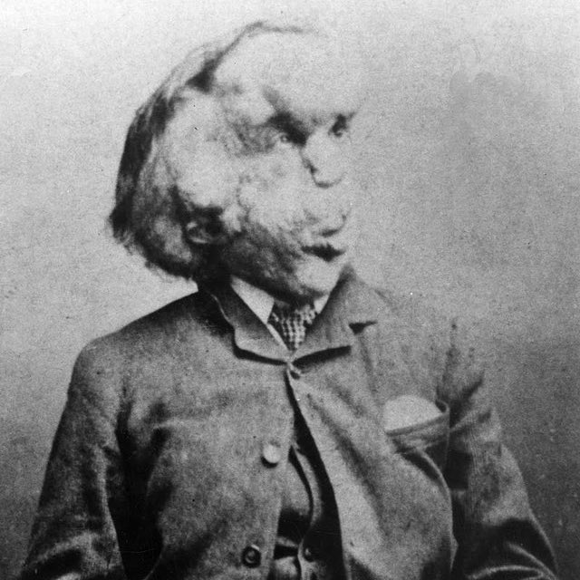 @Morbidful Joseph Merrick, the 'Elephant Man', suffered a tragic life. Born with neurofibromatosis, he was abandoned, exploited, and mistreated as a freak show attraction.

Despite finding refuge at London Hospital, he struggled to lead a normal life, facing social rejection and stigma.