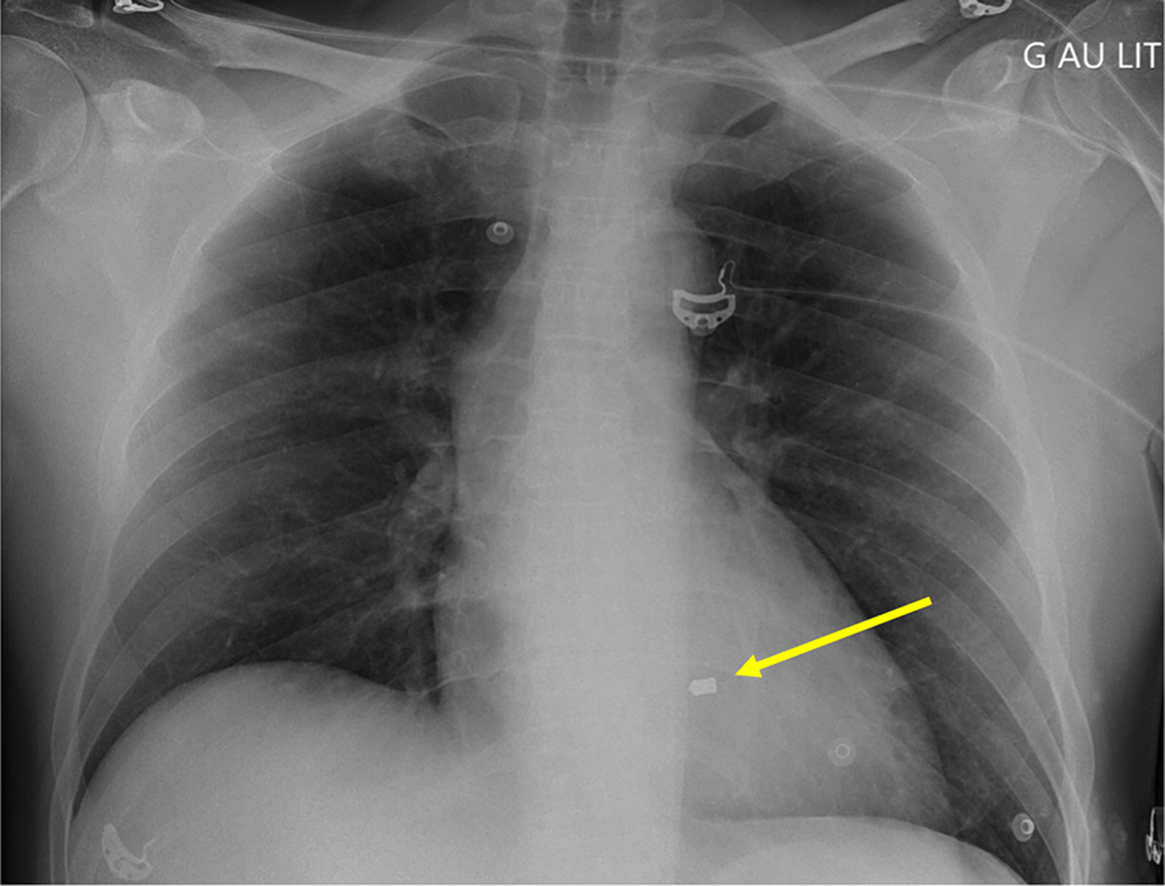 41 y/o ♂️, medically escorted to CICU following an accidental intramyocardial injury secondary to an air-gunshot blast. Injury occurred when a 4.5-mm pellet was accidentally discharged from high-power air rifle approximately 16.5 ft away bit.ly/4aC3j7K #JACCCaseReports