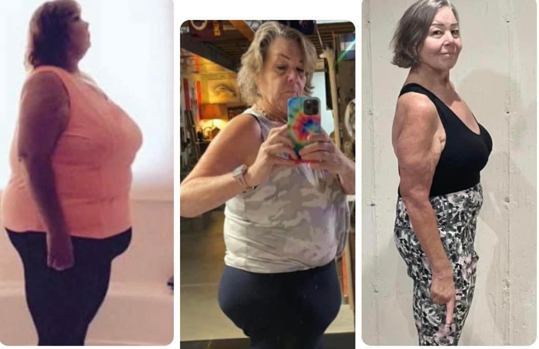 @AJDelgado13 I was over 300 pounds for thirty years. I lost 200 pounds with bariatric surgery, including the 23 pounds of hanging skin I had removed from my core  & new boobs.  Middle pic is shortly before skin removal. I have to get your skin removed.
