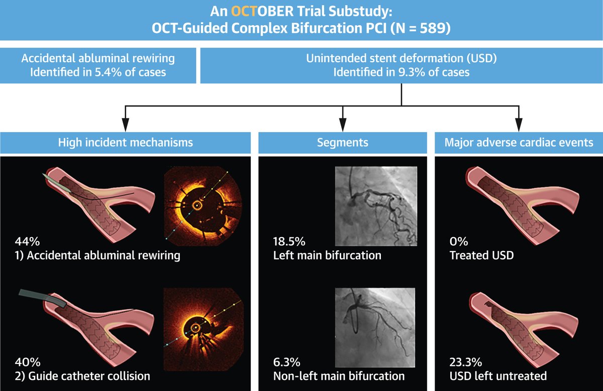 USD was identified in 9.3% of cases during OCT-guided complex bifurcation #PCI. The stent deformations were associated w/ serious procedural complications & worse clinical outcomes. Corrected deformations carried no additional risk. bit.ly/4aCTFSz #JACCINT @LNAndreasen