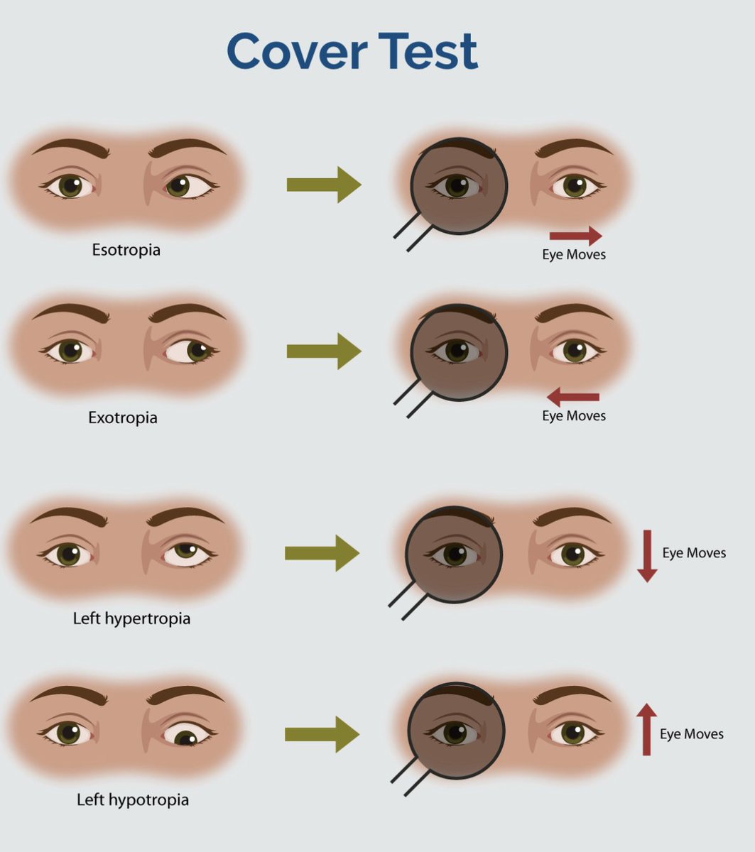Exotropia = eye outward deviation relative to other when focusing on object; Cover test - 1 eye moves to re-establish fixation when other eye covered = true strabismus (tropia) rather than tendency (phoria, only apparent during cover test, not in NL binocular vision)