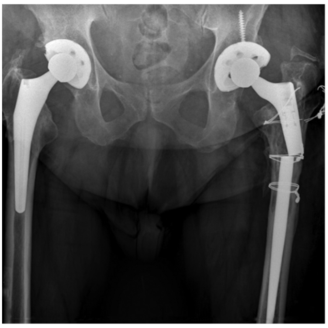 Femoral revision with the ZMR offers satisfactory long-term all-cause revision-free survival, good survival free of stem-related failure, and favourable clinical outcomes. #Radiography #Infection #BJJ ow.ly/1UEY50RG3Oy