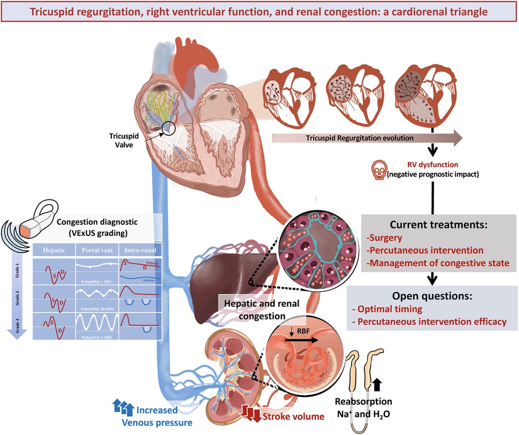 🔴Tricuspid regurgitation, right ventricular function, and renal congestion: a cardiorenal triangle #2023review #openaccess  

frontiersin.org/articles/10.33…
#medtwitterWhat #MedTwitter #CardioEd #medx #medEd #CardioTwitter #cardiotwitter #MedX #MedEd #cardiology #cardiotwiteros #FOAMed