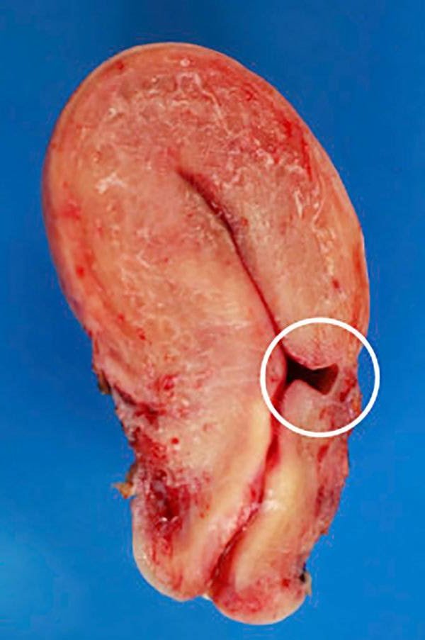 What is the organ? What is the cause of the circled lesion?