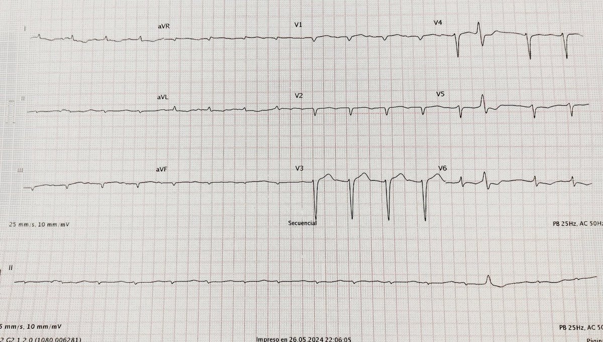 Paciente de 80 años con insuficiencia cardiaca. Fracción de eyección preservada y aumento concéntrico de espesores parietales. Que les parece?