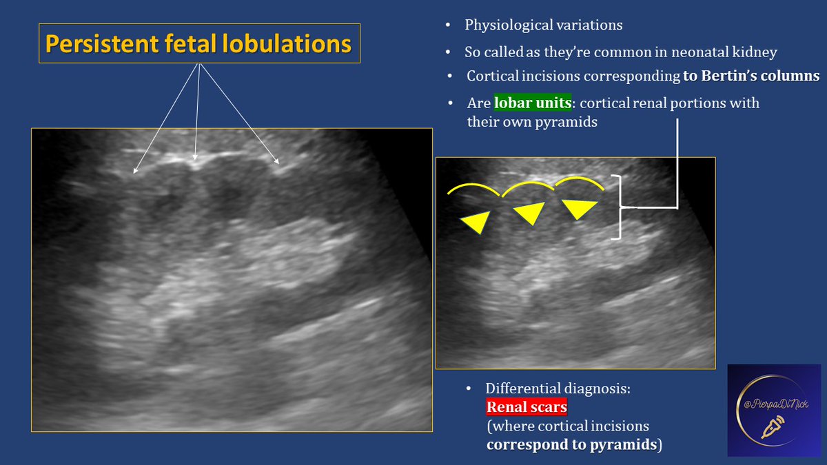 Quite lately this is  #POCUS #renal quiz answer 
We find this ..... 1⃣Is it time to worry? 📷What should we do next ??