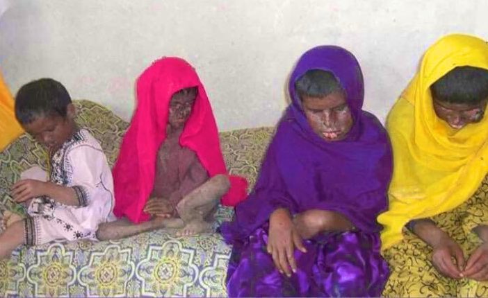 28 مئی ءِ ایٹمی تراک تھنا یک زاہری تجربہ یے نہ ات بلکیں اے تجربہ ءَ چیراندری بے کساس نادرایانی شنگءُ تالانی یے یک چیدگے ات ،کہ چرے ایٹمی تراکءَ پد تابکاری ءِ اسراتءَ چہ کینسرءِ وڑیں مزنیں نادراہی ءَ بگر داں بازیں نادراہی یے بلوچ راجءِ دامنءَ بندوک بوت
#NukeAftermathInBalochistan