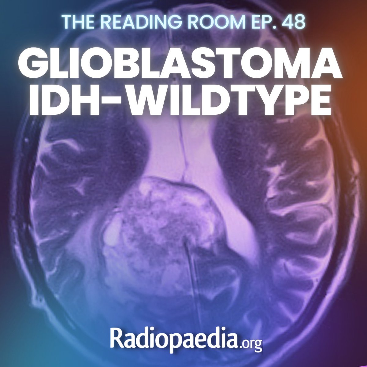 Andrew Dixon (@drandrewdixon) on Twitter photo A new GBM episode of the reading room podcast has arrived with <a href="/frankgaillard/">Frank Gaillard</a>!
The ideal way to keep up to date with glioblastoma terminology and molecular definitions. Plenty of reporting tips too!
๐ง radiopaedia.org/podcast
#neurorad #foamrad A new GBM episode of the reading room podcast has arrived with <a href="/frankgaillard/">Frank Gaillard</a>!
The ideal way to keep up to date with glioblastoma terminology and molecular definitions. Plenty of reporting tips too!
๐ง radiopaedia.org/podcast
#neurorad #foamrad