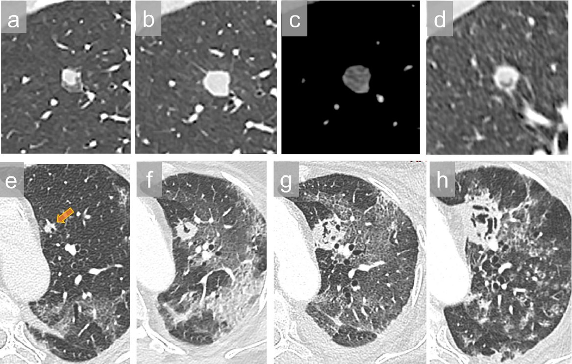 🚨Review of sinus/lung imaging for fungi <a href="/CMIJournal/">Clinical Microbiology and Infection</a> @jobadd 

Lung ➡️ CT preferred. Look for nodules, halo, air crescent, etc.
Sinus ➡️ CT or MRI. Mucosal thickening, opacification, peri-antral fat infiltration, osseous erosion

Added to Aspergillus 📁

transplantid.net/BMI3997L