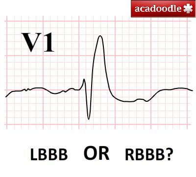 What do you think? LBBB or RBBB? Learn more at acadoodle.com #emergencymedicine #intensivecare #respiratory #respiratorycare #icu #nurses #icunurse #ecg #ekg #cme #cmeonline