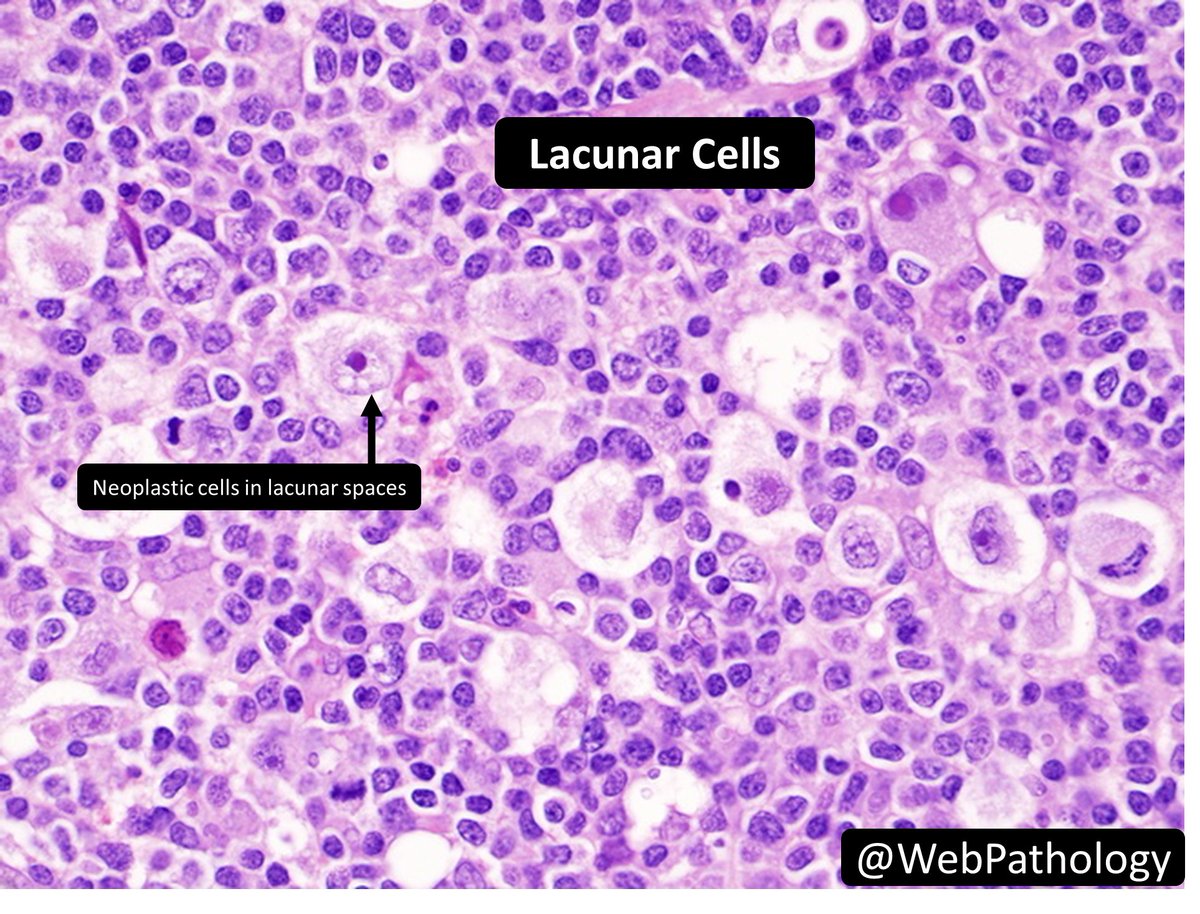 Which cell is characteristically seen in nodular sclerosis CHL?
a) Hodgkin Cell
b) Mummified Cell
c) Reed-Sternberg Cell
d) Lacunar Cell
#HemePath #PathTwitter #PathResidents #Pathology
CHL: Classic Hodgkin Lymphoma