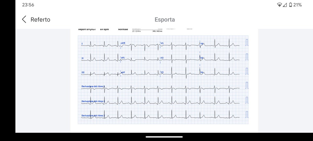 F51 CP since two hours. On the left ECG 1, not OMI according to QoH. On the right ECG after 2 hours, OMI. hSTropo t0 6, 48 t2h. Cath lab and hems activated. Wait and see for the outcome @RobertHermanMD @PendellM @smithECGBlog @The_Nanashi_O @PMcardioApp @ro