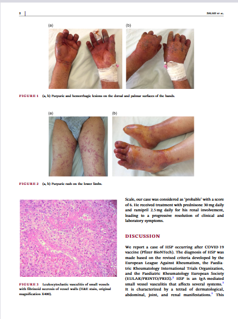 A 74-year-old man presented with an acute purpuric skin eruption occurring 3 weeks after the second dose of SARS-CoV-2 #Pfizer-BioNTech #mRNA vaccine.
tinyurl.com/ct23h4bt