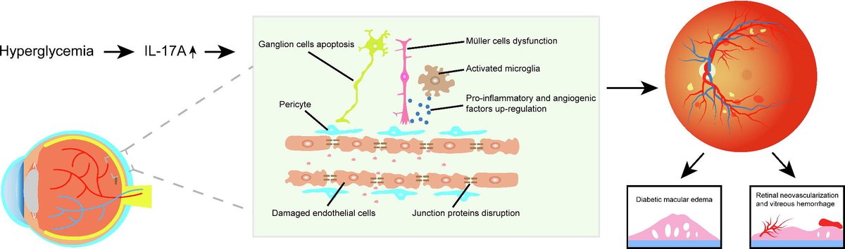 The authors review the pro-inflammatory 🌡️ role of IL-17A in #diabetic retinopathy, with a focus on how IL-17A impacts inflammation and #angiogenesis crosstalk. 

🔗 bit.ly/3yuM0bq