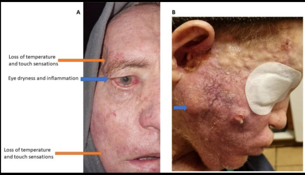 Studio di caso clinico: Secchezza e irritazione degli occhi. Perdita della temperatura e delle sensazioni tattili nelle regioni oftalmiche e della bocca. Condizione 5 mesi dopo la VACClNAZlONE. excli.de/index.php/excl…