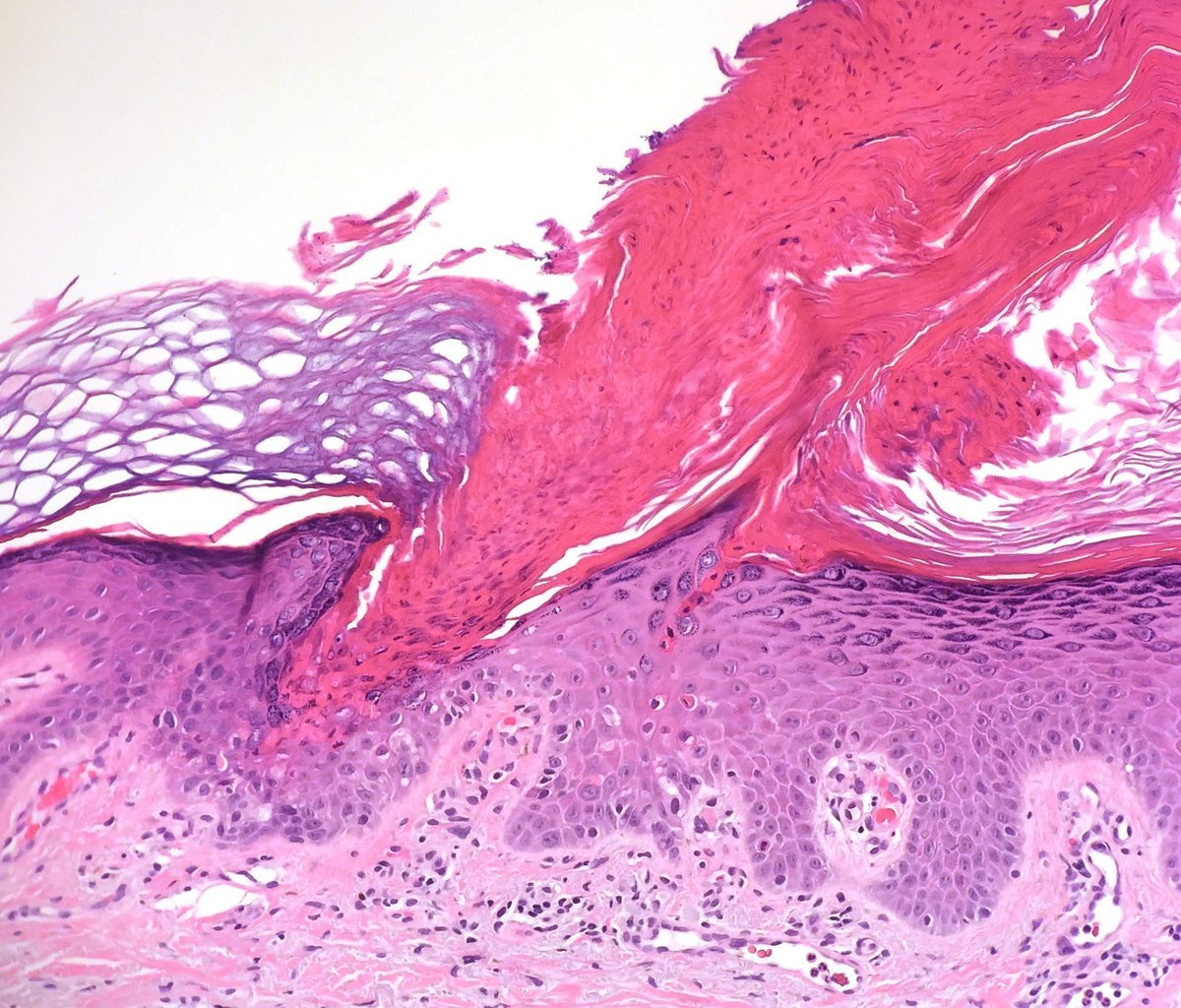 You can't find one much better than this! Name the structure & diagnosis.
Answers: youtu.be/wPNRfiDCj0A?si… 
Low power pic: kikoxp.com/posts/10640
#pathology #pathTwitter #dermpath #dermatology #dermatologia #dermtwitter