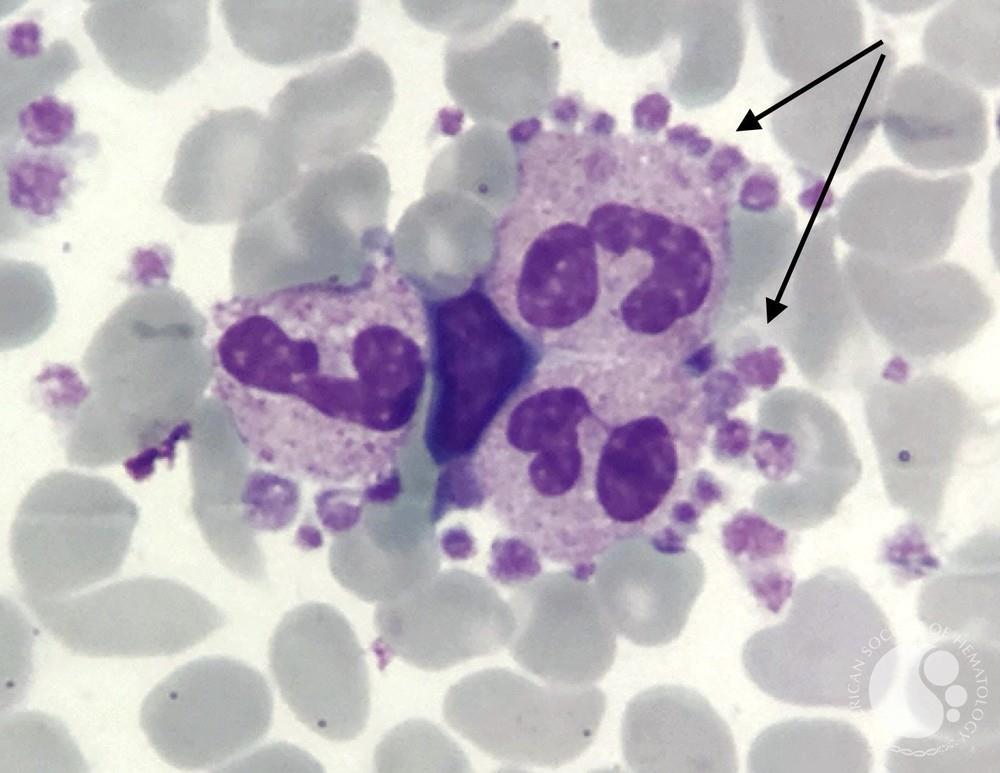 And this, ladies and gentlemen, is why you need a blood smear 👇🏼

#MedTwitter