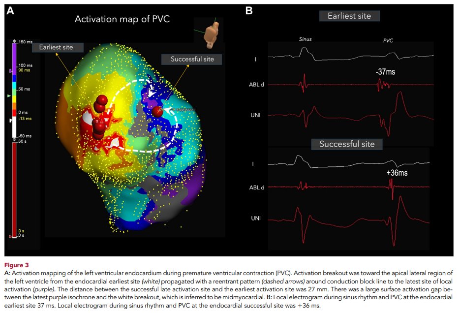 <a href="/DrRoderickTung/">Roderick Tung</a> et al is now ablating "latest" endo activation, too?!  Great mechanistic paper on the reentrant PVC.  
heartrhythmjournal.com/article/S1547-…
#EPeeps
