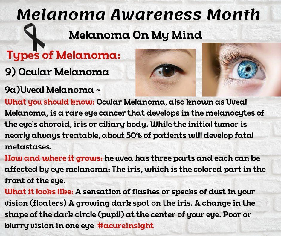 🖤Melanoma Awareness Month🖤
9) Ocular Melanoma 
9a:Uveal melanoma 
9b: Conjunctival melanoma 
What you should know: Ocular Melanoma, also known as Uveal Melanoma, is a rare eye cancer that develops in the melanocytes of the eye’s choroid, iris or ciliary body.
(Con’t below 👇)
