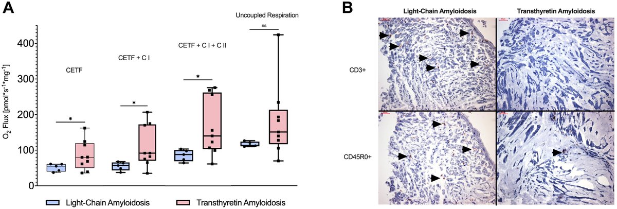 New 🔥 article from our Düsseldorf lab, just published in @JACCJournals Heart Failure: 
Cardiac light-chain vs. transthyretin #amyloidosis have distinct mitochondrial characteristics @vofab @DanielScheiber @RalfWestenfeld @amin_polzin @DGK_org @BiykemB  
jacc.org/doi/10.1016/j.…