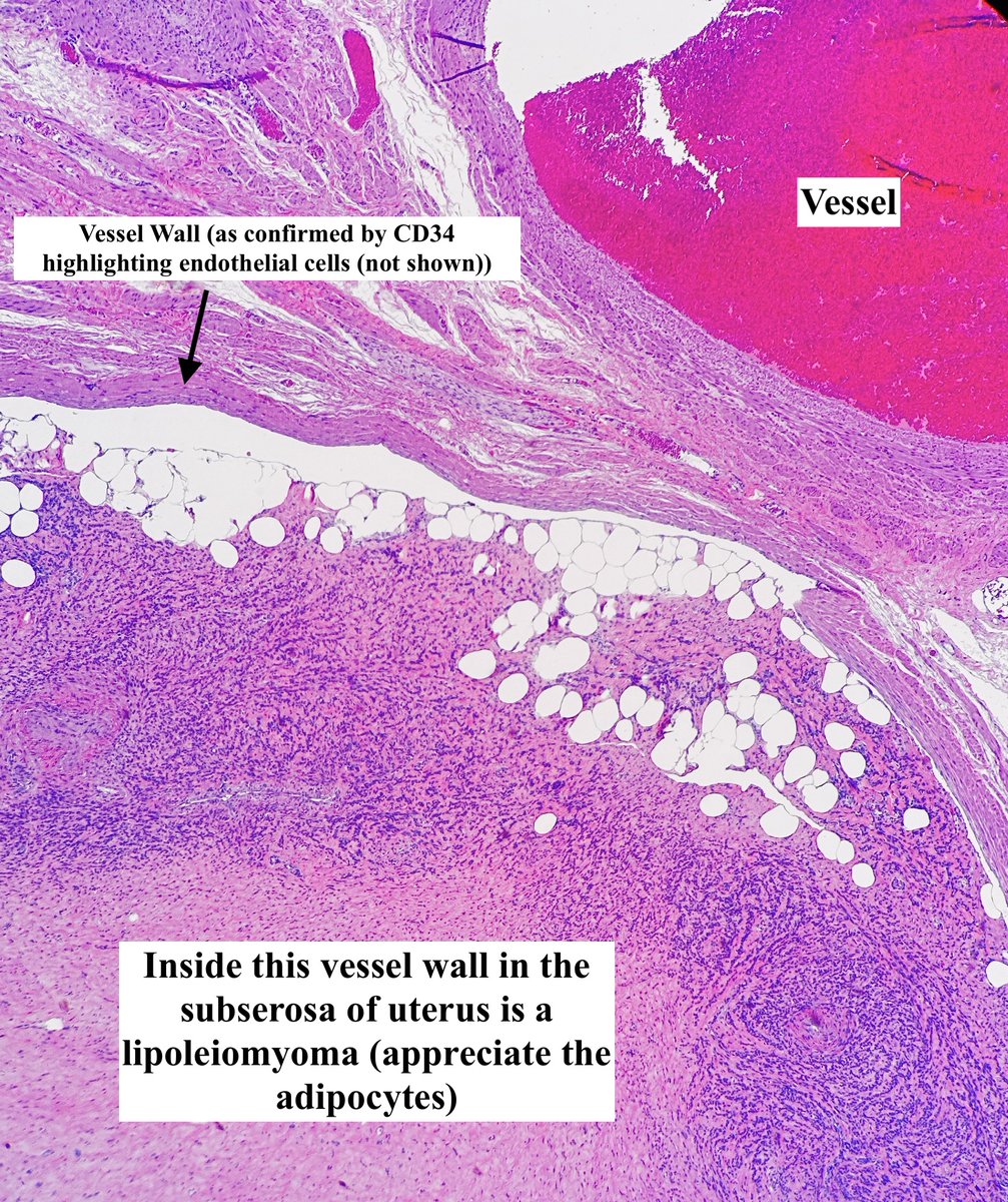 Path4People's tweet image. Intravenous (Lipo)Leiomyomatosis    

• A mouthful but basically a fibroid w fat elements inside a vessel that itself is outside a fibroid  
• Not staged 
• Extrauterine extension occurs ~ 30% of times 
• This case also had a broad ligament leiomyoma  

#pathagonia #gynpath