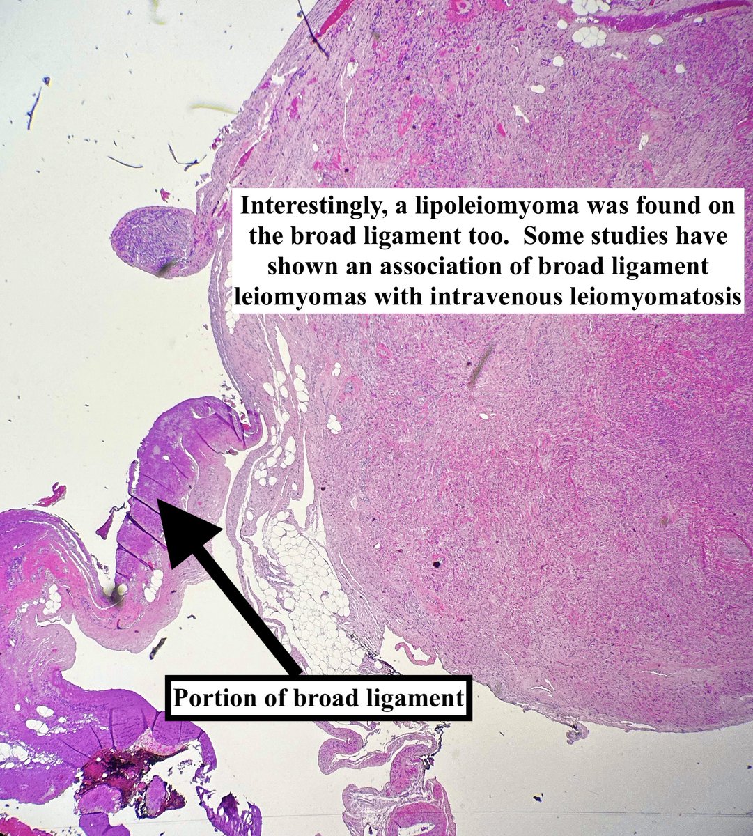 Intravenous (Lipo)Leiomyomatosis    

• A mouthful but basically a fibroid w fat elements inside a vessel that itself is outside a fibroid  
• Not staged 
• Extrauterine extension occurs ~ 30% of times 
• This case also had a broad ligament leiomyoma  

#pathagonia #gynpath