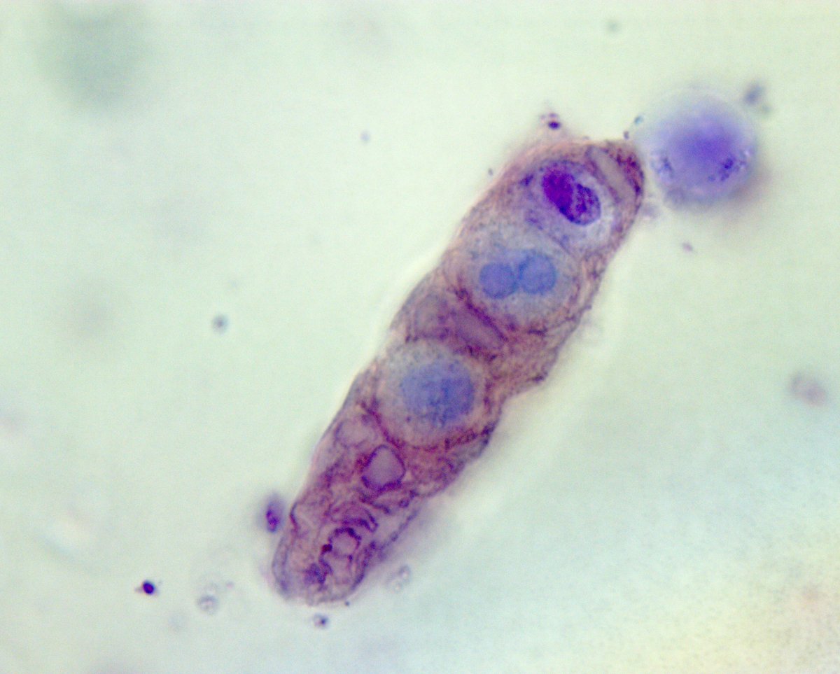 VelezNephHepato's tweet photo. #UrinarySediment from pt w/newly diagnosed lymphoma and AKI. Findings suggest paraneoplastic crescentic glomerulonephritis: acanthocytes, RBC cast, WBC cast (w/RBCs), and fibrinous cast. All serologies normal or neg. Kidney biopsy planned #UrineMicroscopy https://t.co/r2FxLNseir