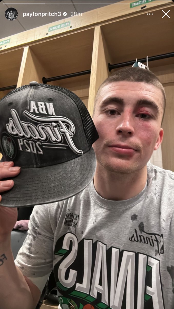 Celtics_Junkies's tweet photo. Payton Pritchard on his IG Story after being kicked in the face tonight 😂 https://t.co/evsa7D0FXR
