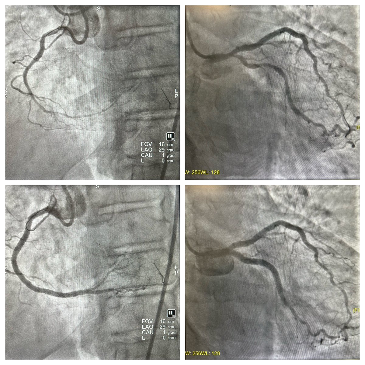 67👨🏼‍🦳. MV PCI. RCA CTO crossed w/ Finecross & FXTR. LM-LCx provisional stenting with KB & DCB to ostial LAD.